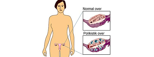 Polikistik Over Sendromu (PCO)