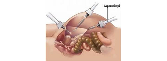 Laparoskopik Cerrahi Nedir?