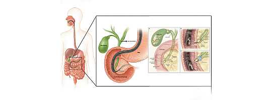 ERCP Nedir?